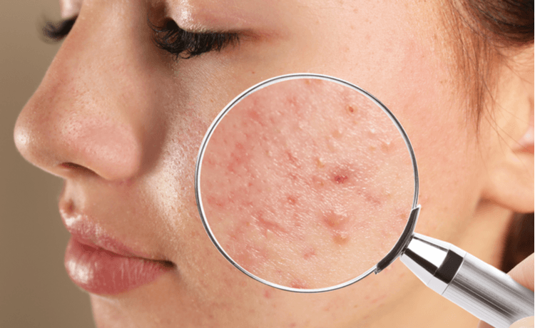 5 Dicas No Tratamento Da Acne