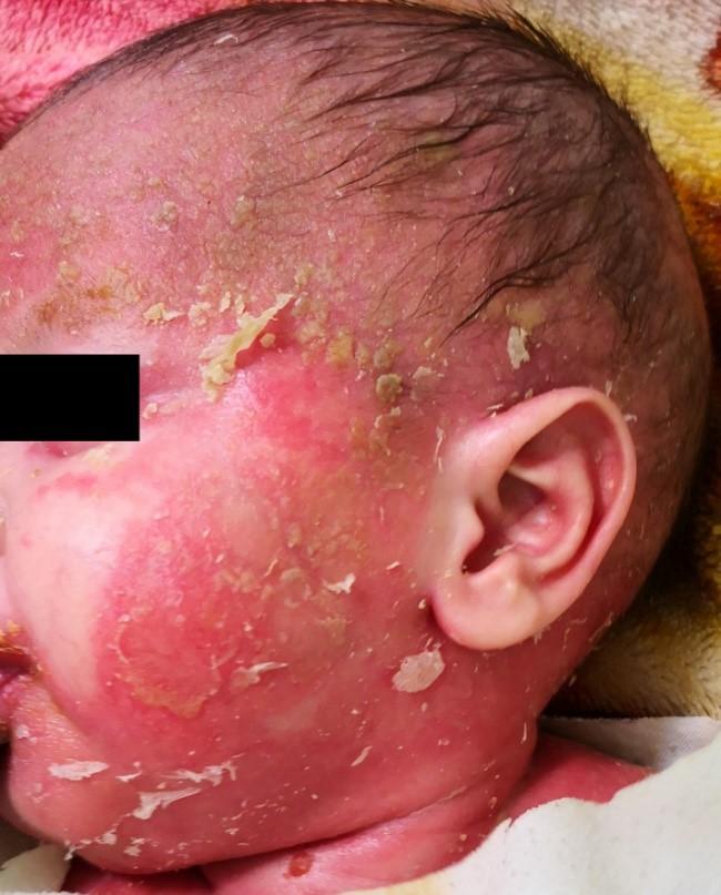 Síndrome De Netherton: Principais Características Clínicas