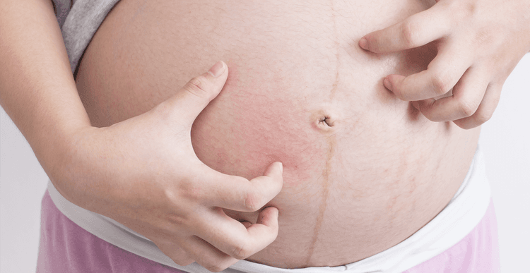 Quando Pensar Em Colestase Intra-hepática Da Gravidez?