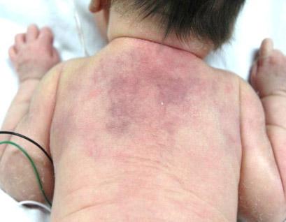 Necrose Gordurosa Subcutânea Do Recém-nascido: A Que Precisamos Ficar Atentos?