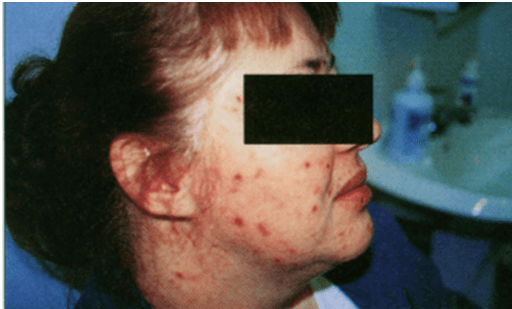 Escoriações Neuróticas: Interface Da Dermatologia E Da Psiquiatria