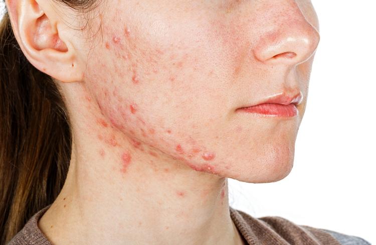 Acne Da Mulher Adulta: Quais Exames Complementares Solicitar?