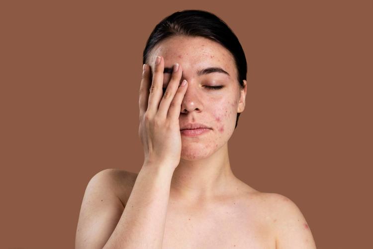 Acne Da Mulher Adulta: Da Definição À Etiopatogenia