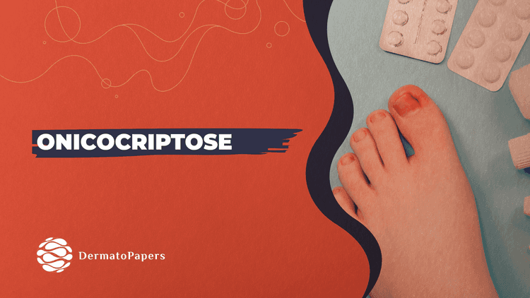 Podcast Dermatopapers: Onicocriptose