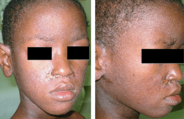 Dermatite Infecciosa Pelo Htlv-1