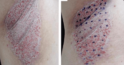 Opções Terapêuticas Para A Doença De Hailey-hailey