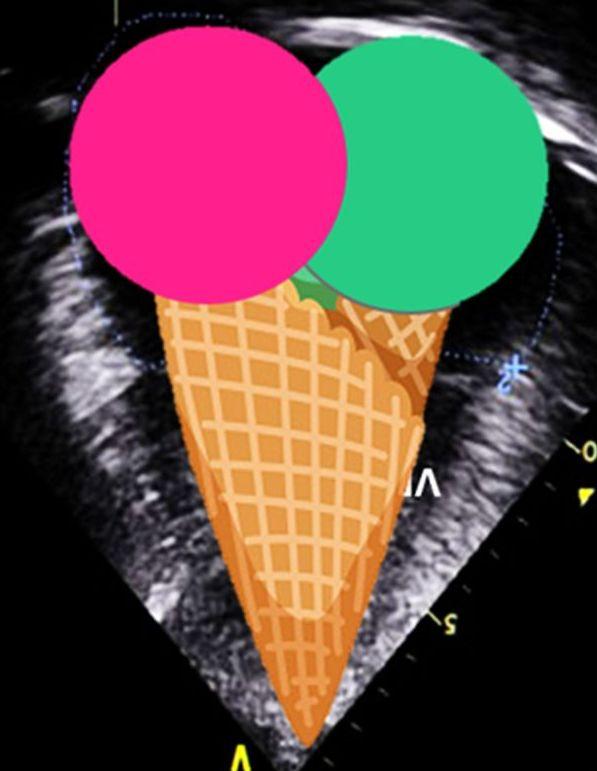 POCUS: Você conhece o sinal do “Sorvete Duplo de Casquinha” ?