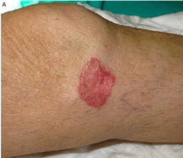 Qual A Relação Entre Poroceratose E Neoplasias Malignas?