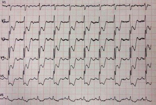 Curso básico de eletrocardiograma – parte 15 – Diagnóstico diferencial de infra-desnivelamento do segmento ST