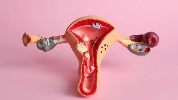 Tratamento do prolapso genital