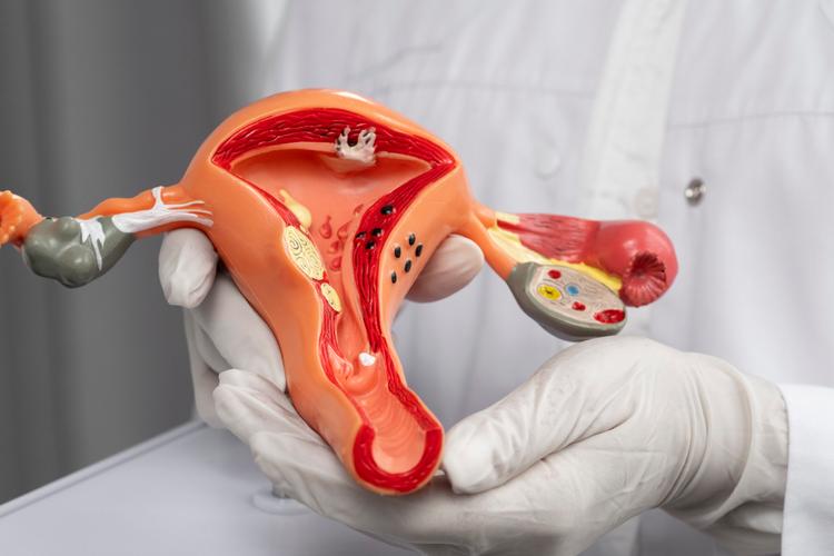 Sangramento uterino anormal – Tratamento