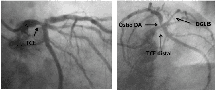 Prova funcional de alto risco: será que seu paciente tem lesão de tronco?