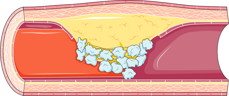Infecção pode aumentar o risco de infarto agudo do miocárdio?