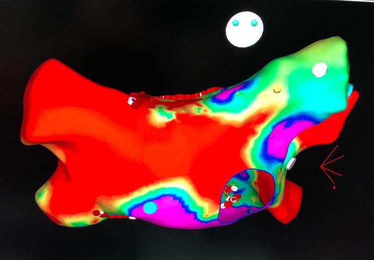 Ablação de Fibrilação Atrial em 2019: Mudaram as Indicações?