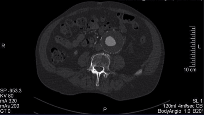 O que fazer com este paciente com aneurisma de aorta?