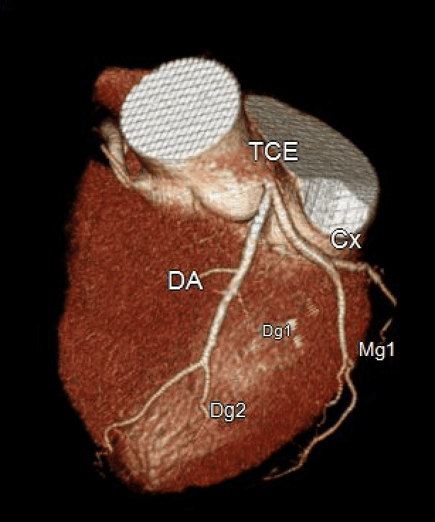 Estudo DISCHARGE: A angiotomografia de coronárias vai substituir o cateterismo cardíaco?