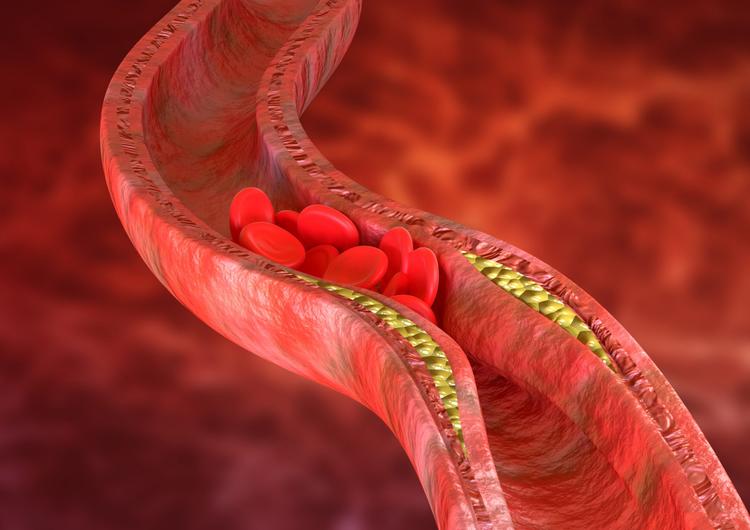Nova droga para tratar doença cardiovascular aterosclerótica
