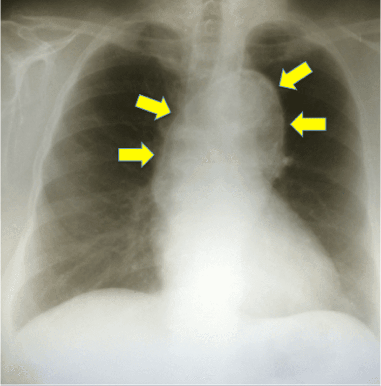 Características epidemiológicas da dissecção de aorta