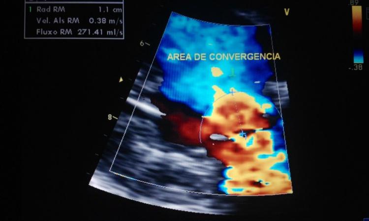 Como graduar insuficiência mitral pelo ecocardiograma?