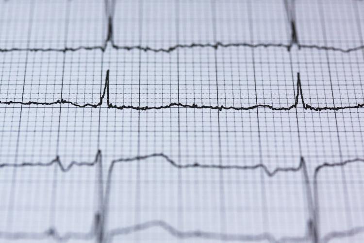 Eletrocardiograma no atleta – o que você precisa saber?