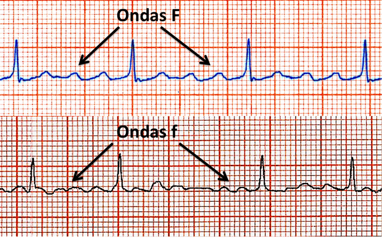O Risco de AVC em Pacientes com Fibrilação Atrial e Flutter Atrial é o Mesmo?