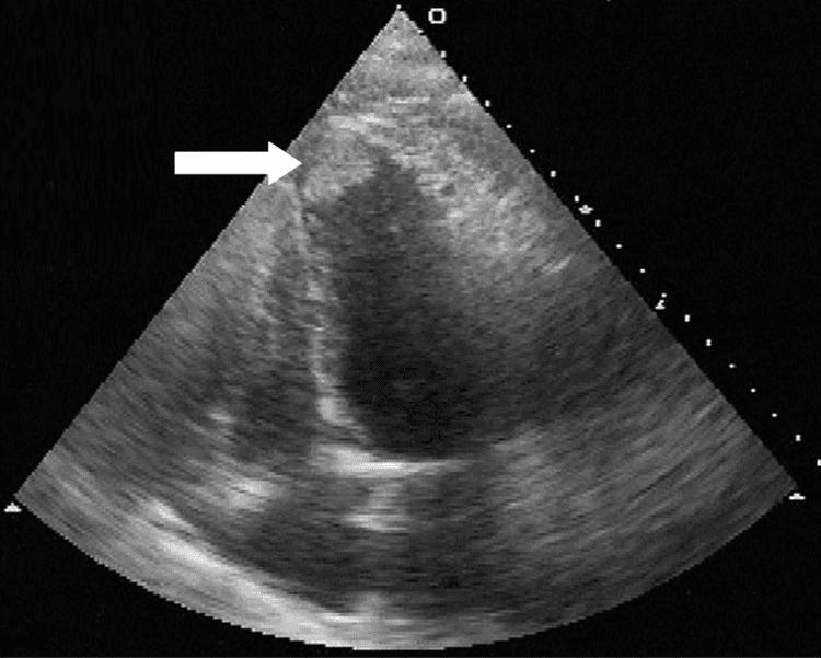 Insuficiência cardíaca, trombo ventricular e ritmo sinusal: anticoagular por quanto tempo?