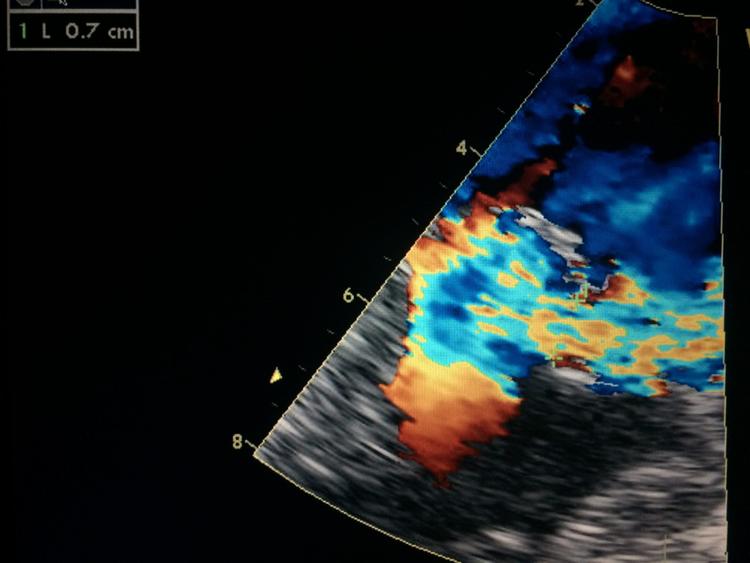 Curso básico de ecocardiograma – o que é vena contracta?