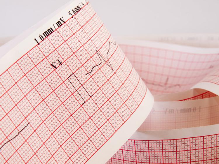 Como diferenciar o supra de ST da pericardite do supra de ST da repolarização precoce?
