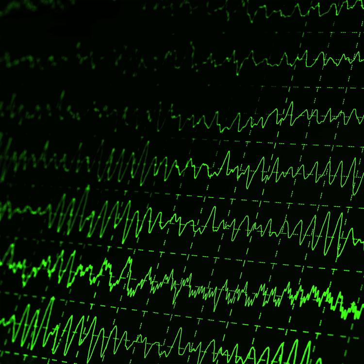 Desmascarando o Padrão Eletrocardiográfico de Brugada Tipo I. Como Fazer o Teste da Ajmalina?