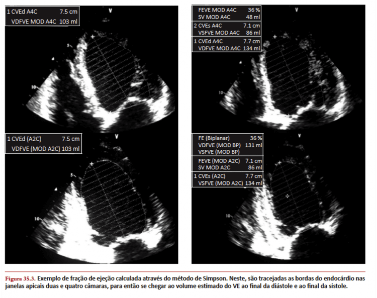 Como interpretar os valores de strain do ecocardiograma?