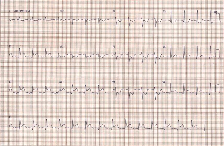 Supra de ST côncavo ou convexo? Qual a importância disto?