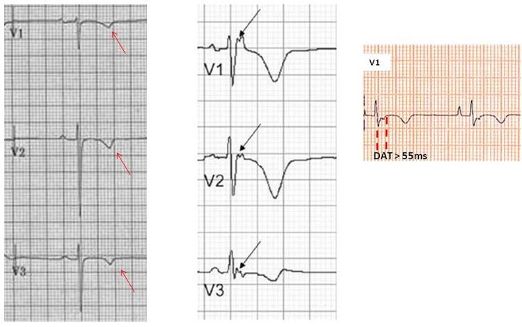 Você Conhece as Alterações Eletrocardiográficas da Displasia Arritmogênica do VD?