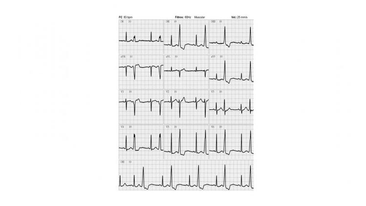 Extrassístoles ventriculares no teste ergométrico: e agora?