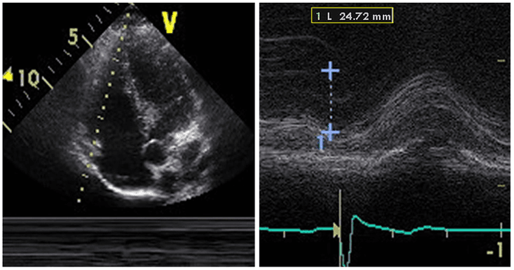 Curso básico de eco – o que é TAPSE????