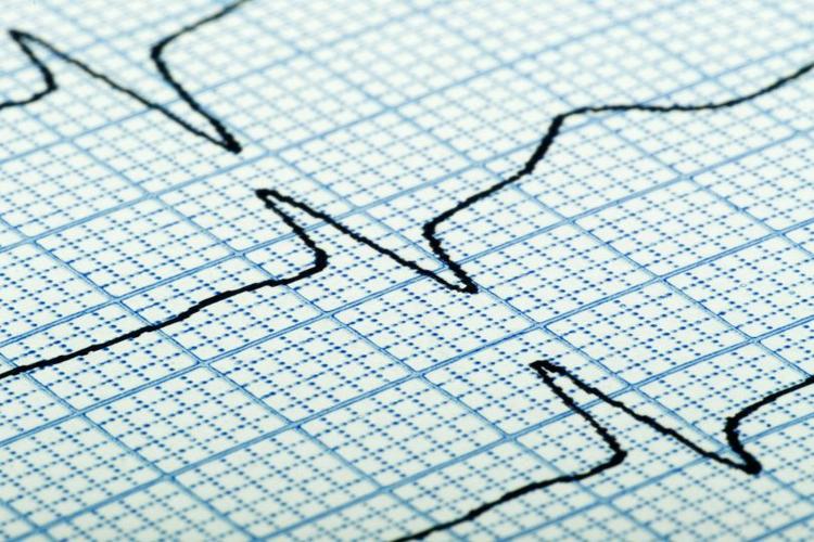 Desafio de ECG – Este ECG é Compatível com Qual Doença Abaixo?