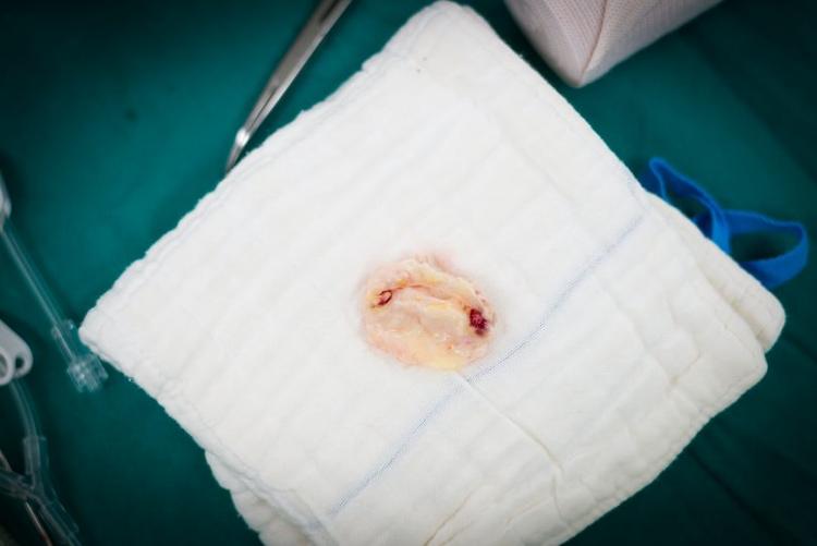 Qual o alvo de INR a ser atingido em pacientes com próteses valvares?