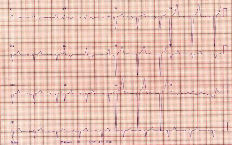 Você sabe quais os critérios diagnósticos de bloqueio de ramo esquerdo?