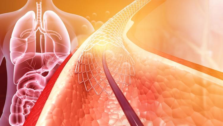 implante TAVI em imagem montada com corpo humano atrás