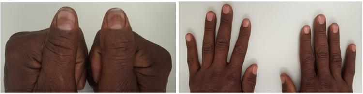 Caso clínico: Diarreia crônica e possível doença de Whipple