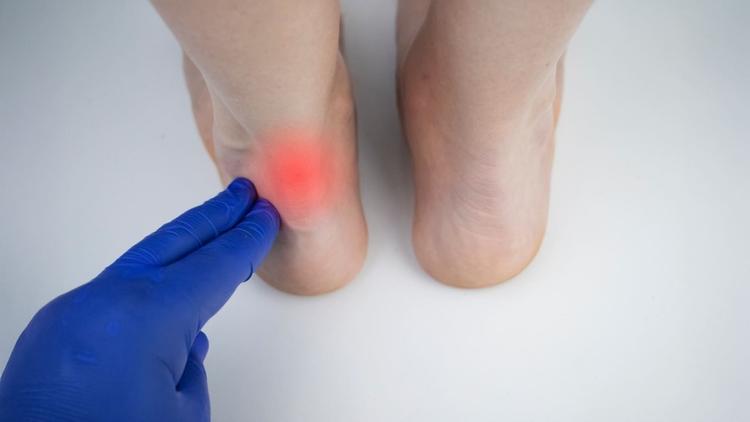 Trombose venosa profunda após ruptura do tendão de Aquiles