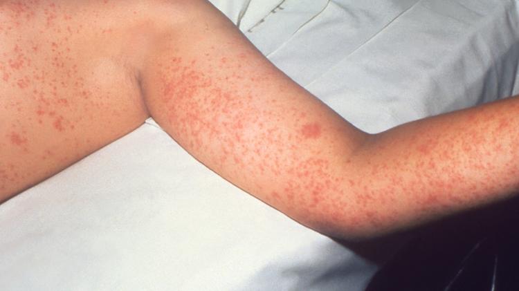 Sarampo: principais aspectos de uma doença reemergente