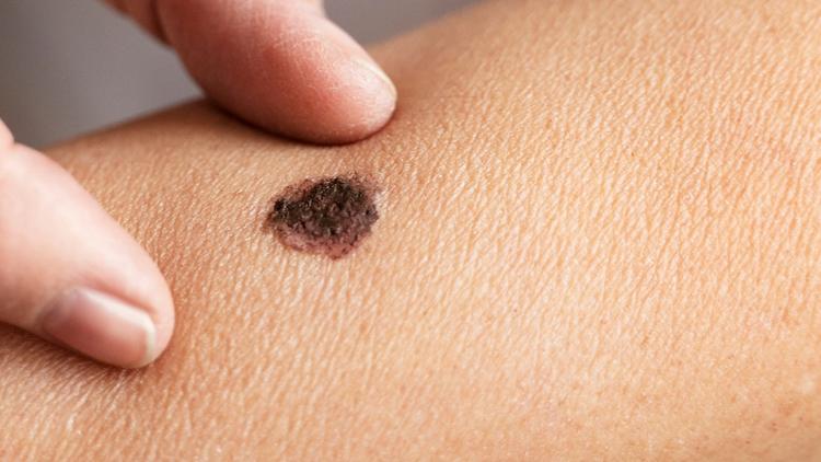 Nevo Congênito: definição, apresentação clínica e manejo