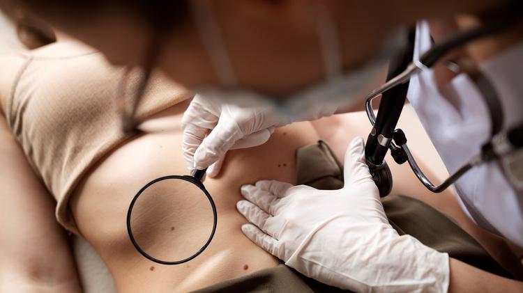 Nevo de Reed e nevo de Spitz: definição, dermatoscopia e manejo