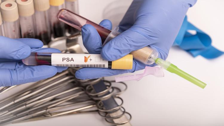 ASCO 2025: Profissional de saúde manipulando tubo de coleta de sangue com o registro PSA (exame que auxilia na detecção de câncer)