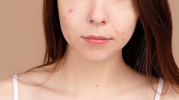 A eficácia e segurança de um novo nutracêutico para acne leve a moderada