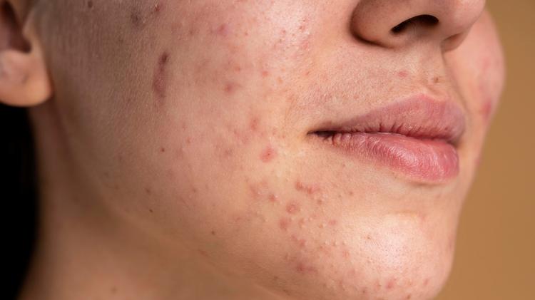 Cicatrizes de acne: protocolo para definir desfechos em ensaios clínicos