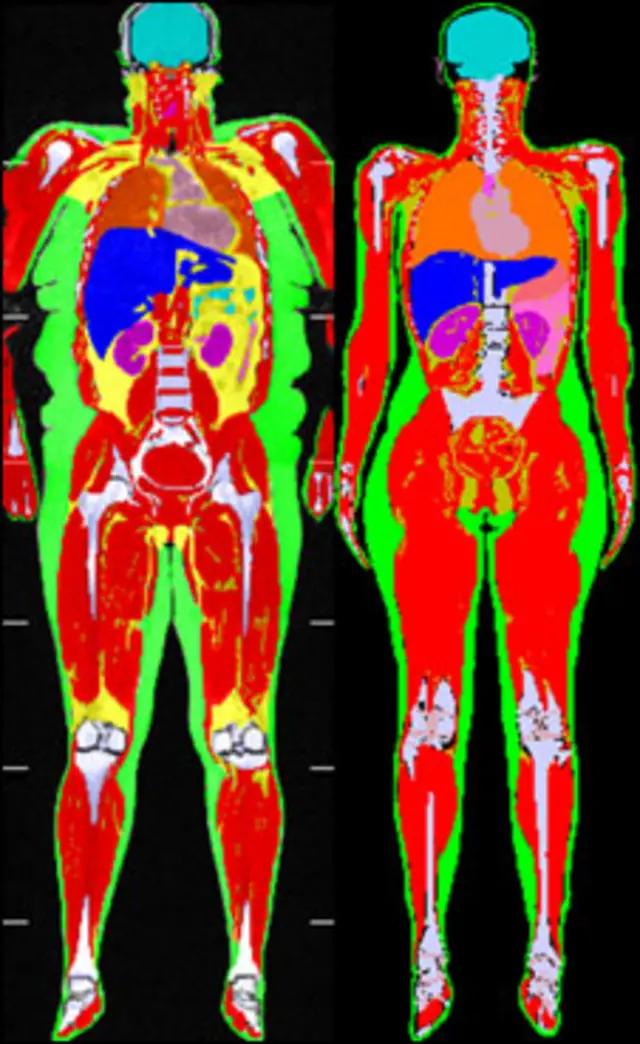 Gordura intra-muscular e o risco cardiovascular