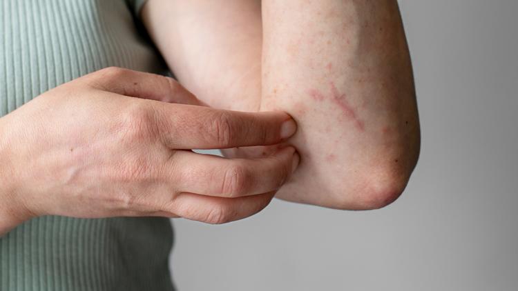 Hidradenite supurativa x Síndrome de Down