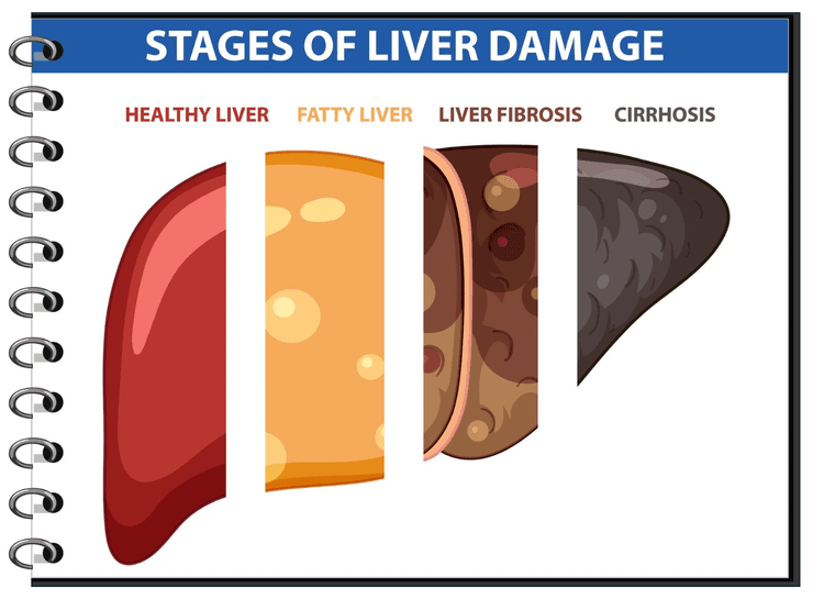 Novo consenso da ADA sobre doença hepática esteatótica no diabetes: diagnóstico
