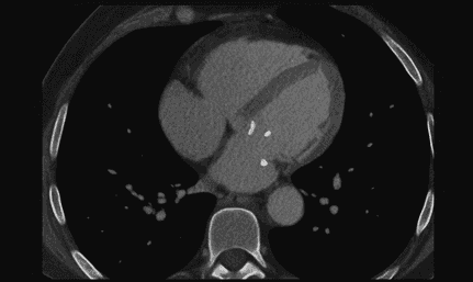 O que o endocrinologista deve saber sobre escore de cálcio coronariano?